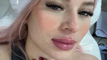 La joven mostró cómo lucía con rellenos en los labios - crédito Ornella Sierra / Instagram
