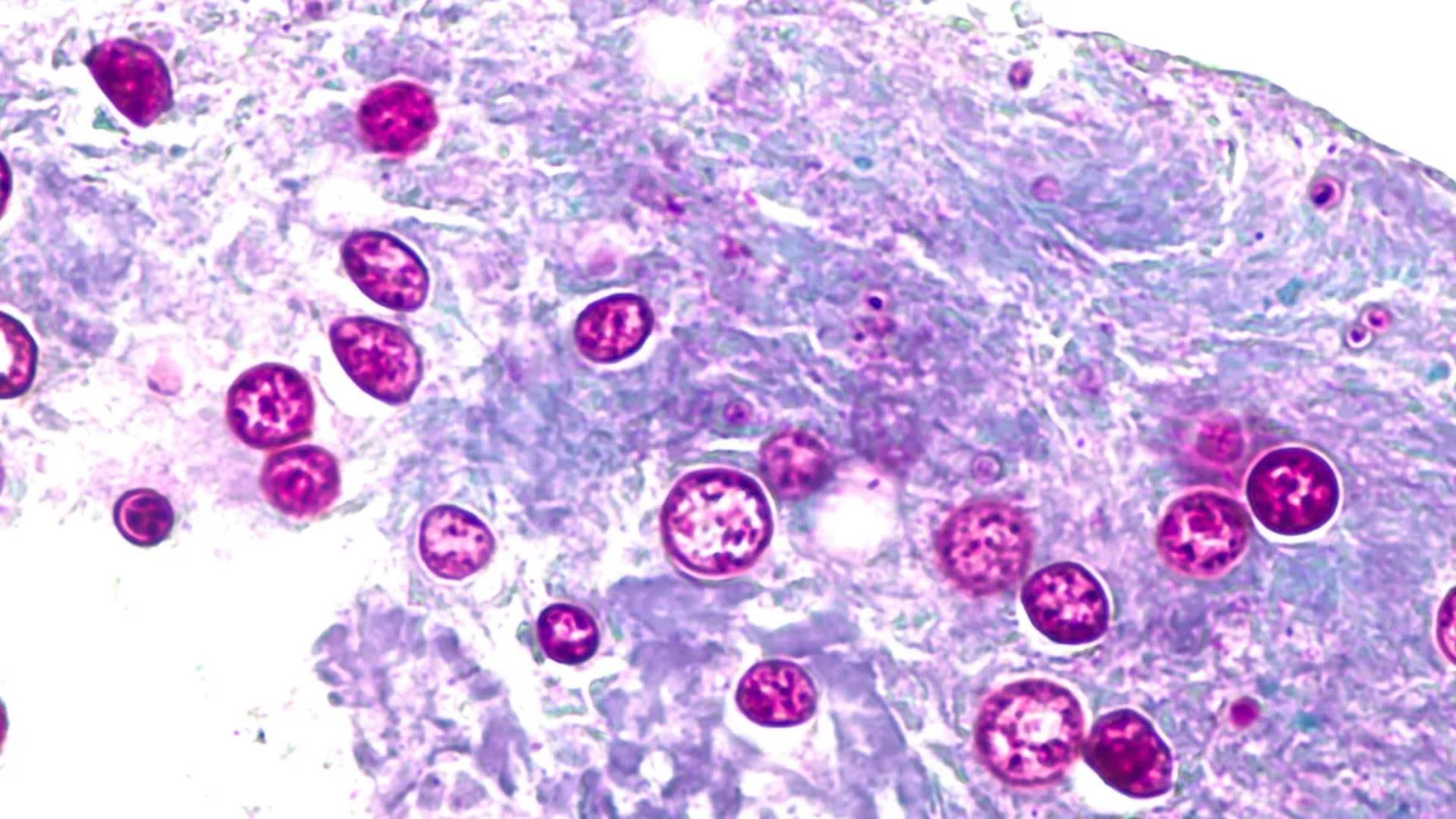 Miami-Dade y Broward suman 11 casos confirmados de ciclosporiasis dentro del brote que afecta a Florida (CDC)