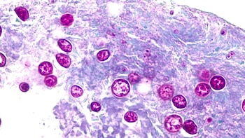 Brote de parásito intestinal ya afecta a más de 20 condados de Florida y registra 50 casos