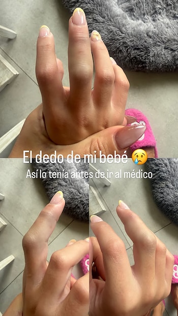 Close-up de una mano adulta sosteniendo la mano de un niño, que muestra un dedo visiblemente inflamado o lesionado. Se ven uñas con esmalte amarillo