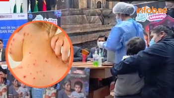 Brote de sarampión en Puno supera los 80 casos y pone en alerta a autoridades