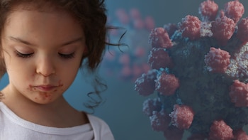 Virus Coxsackie o enfermedad de manos, pies y boca: ¿Cuántos días es recomendable suspender las clases para evitar el brote?