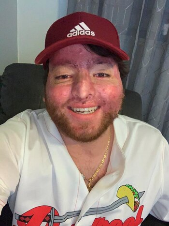 Fotografía personal cedida donde aparece Alexis Joel Hernández, un estudiante de medicina puertorriqueño que sufrió quemaduras graves mientras estudiaba en México, y pide ayuda para afrontar el pago de una factura médica de 1,7 millones de dólares por los tratamientos recibidos en el hospital militar Brooke Army Medical Center en San Antonio (Texas, EE.UU.) que su aseguradora no paga. EFE/Alexis Joel Hernández