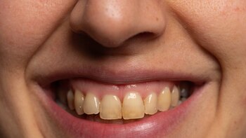 Un dentista explica qué significa el color amarillo de los dientes y qué indica sobre la salud de las personas: “El blanco natural no existe”
