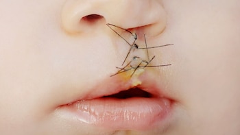 Bloqueo nervioso evita necesidad de