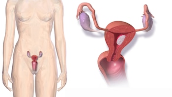 El cáncer de endometrio suele
