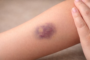 Hematoma, moretón, derrame.- (Imagen ilustrativa