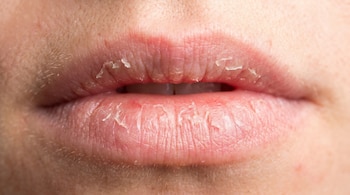 Primer plano de unos labios humanos con piel seca y escamada, mostrando claros signos de agrietamiento y deshidratación.
