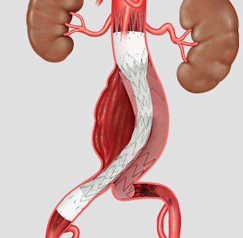 En casos de pacientes con