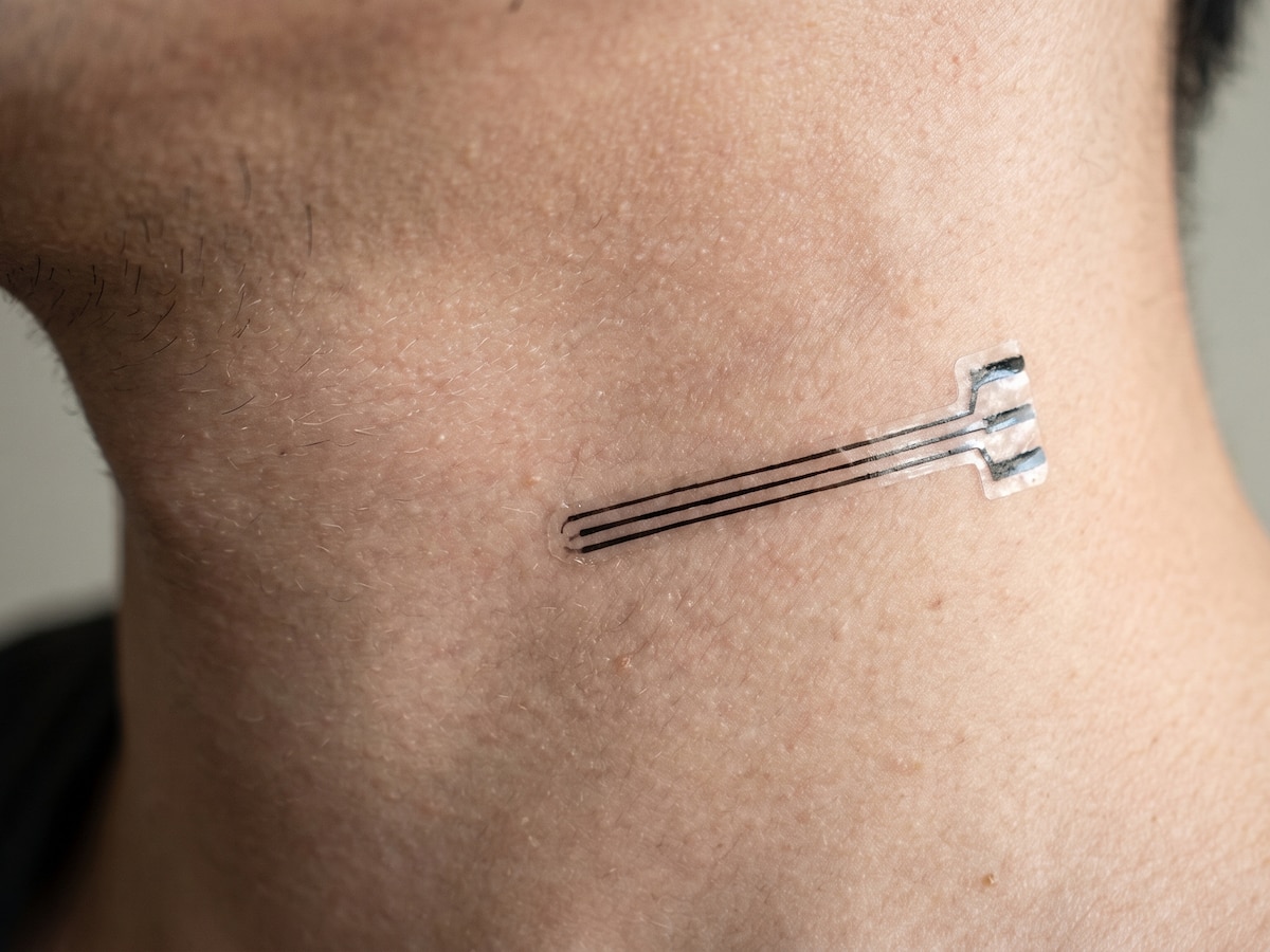 Adiós a las suturas: el nuevo implante elástico que revoluciona el tratamiento de la presión arterial - Infobae