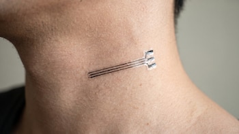 Adiós a las suturas: el nuevo implante elástico que revoluciona el tratamiento de la presión arterial