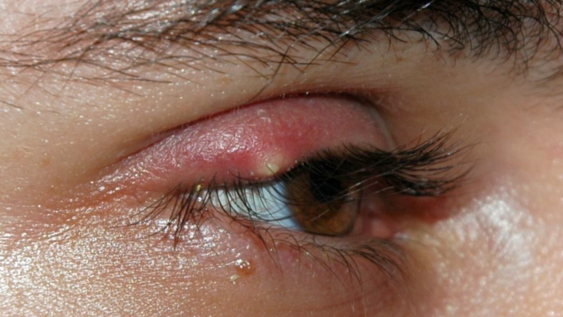 El orzuelo aparece como un bulto rojizo, caliente y doloroso (Wikipedia)