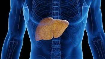 El hígado graso aumenta las probabilidades del cáncer de colon más mortal, según un estudio