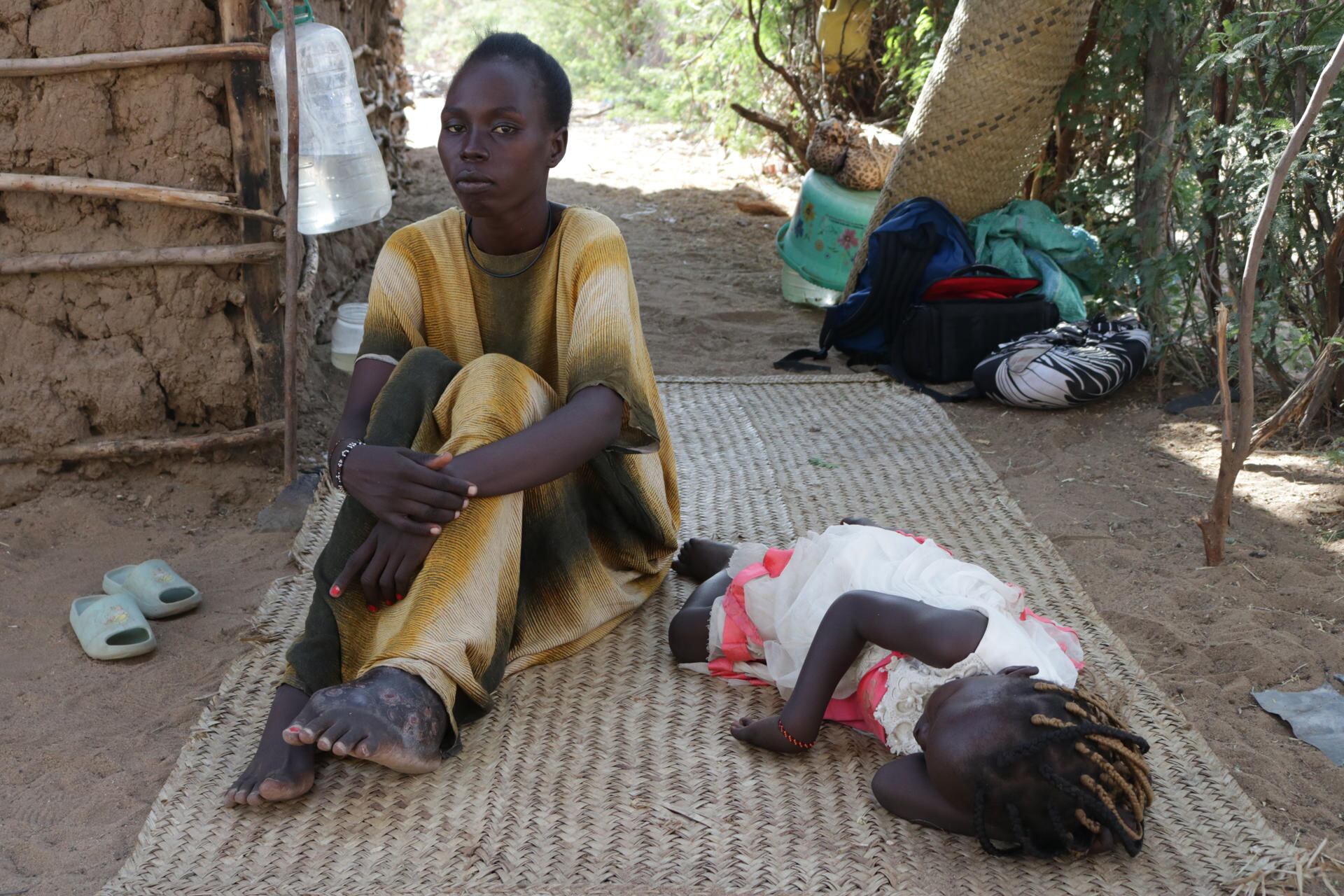 La enfermedad tiene dos variedades: la bacteriana y la fúngica, mucho más grave. Ataca los tejidos, empezando por la piel, y, cuando alcanza el hueso, la única opción es la amputación. EFE/Lucía Blanco
