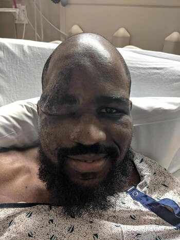 Anderson mostró las secuelas que