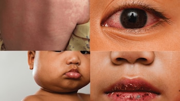 La enfermedad de Kawasaki afecta