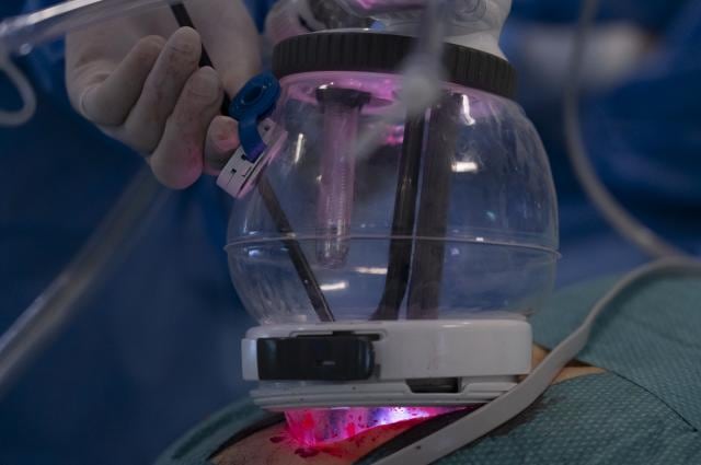 Un equipo quirúrgico del Hospital de Bellvitge emplea un dispositivo de incisión única durante un trasplante renal con asistencia robótica. (Hospital de Bellvitge)
