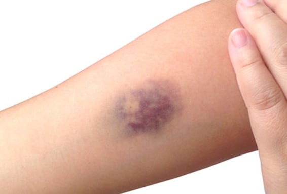 Moretones sin golpe: causas reales, señales de alerta y cómo actuar