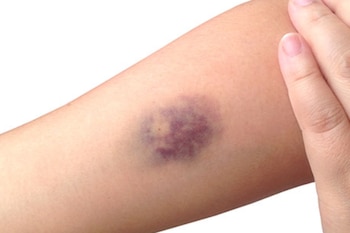 5 señales sutiles de que el cuerpo necesita más nutrientes, según un médico de Harvard 13 Moretones frecuentes podrían sugerir carencia de vitamina C y K1, esenciales para el colágeno y la coagulación