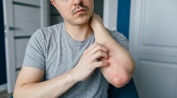 Un hombre con camiseta gris se rasca la piel enrojecida y descamada del antebrazo.