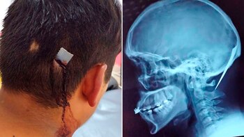 Insólito: lo apuñalaron en el