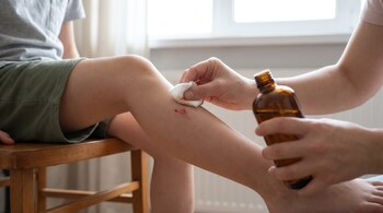 Primer plano de una persona sentada mientras otra persona limpia una herida superficial en su pierna con un trozo de algodón y una botella de agua oxigenada.