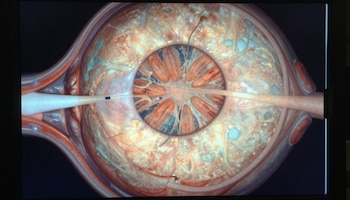 La retinopatía diabética es la