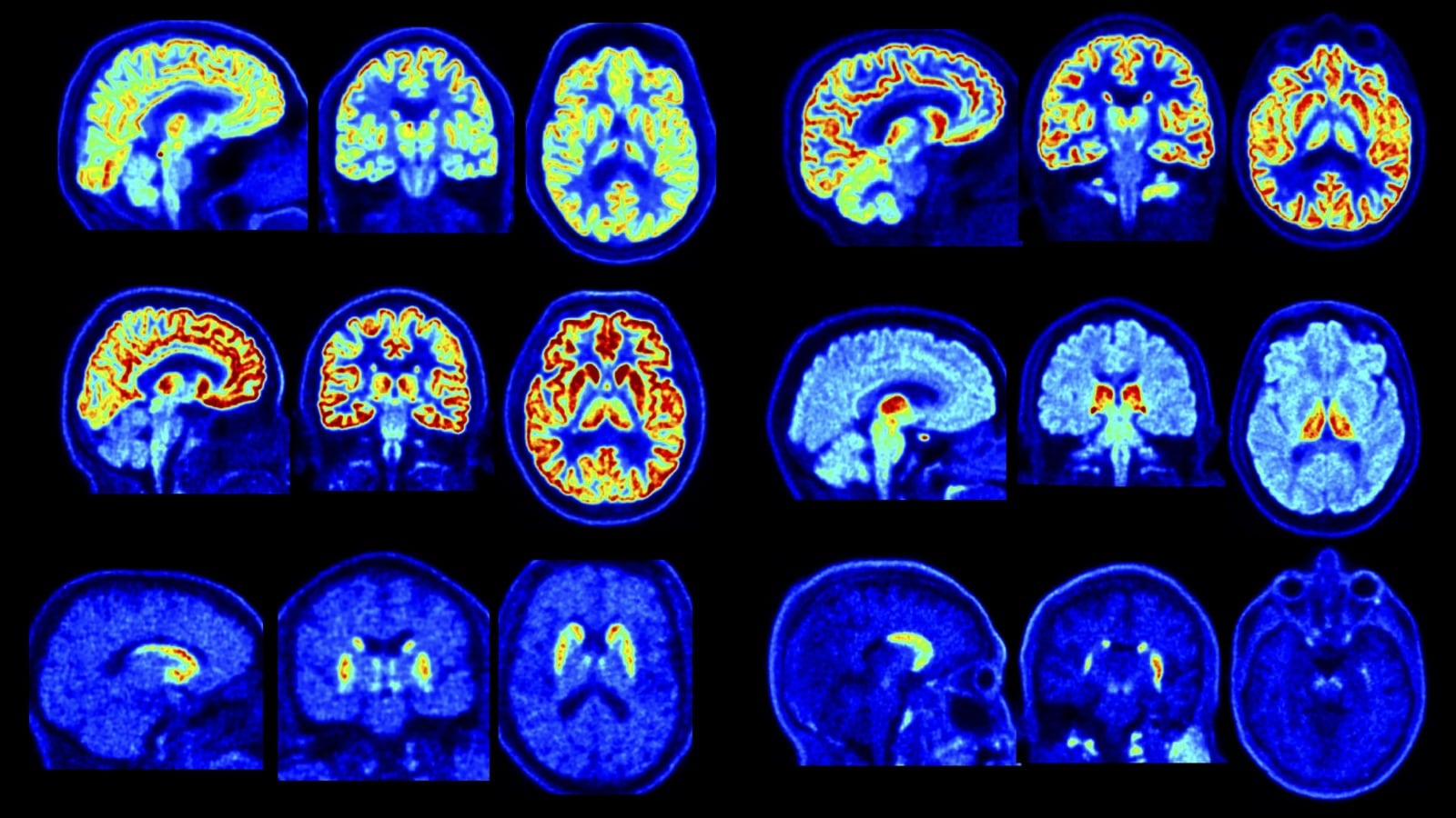 El escáner PET NeuroEXPLORER de Yale permite detectar trastornos cerebrales en etapas tempranas con mayor precisión (Universidad de Yale)