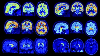 Nuevo escáner PET permite detectar