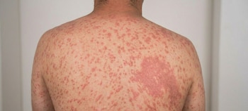 Autoridades buscan evitar una mayor propagación del virus. (FOTO: TNH)