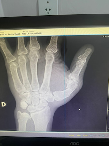 Freitas sufrió una fractura en