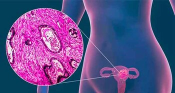 El cáncer cervical, también conocido