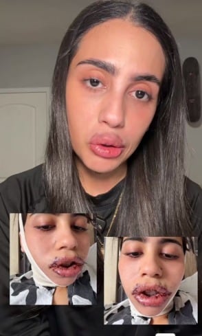 La mujer denuncia inyección de silicona con aceite industrial en sus labios (Hillary.escriba)
