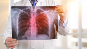 La tuberculosis es una enfermedad