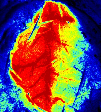 Un equipo internacional logró proteger el cerebro tras un ACV mediante hibernación farmacológica en pacientes humanos conscientes (Crédito: Shuaili Xu, Universidad Médica Capital)