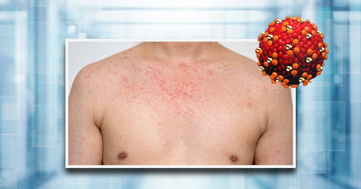 Alerta de sarampión en México: Secretaría de Salud emite advertencia por aumento de casos