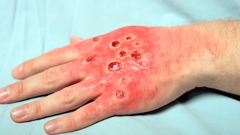 Epidermolisis bullosa piel sensible piel de cristal