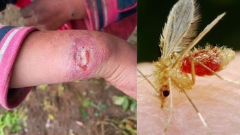 Una madre, Yolanda Becerra, denuncia la escasez de medicamentos necesarios para tratar la leishmaniasis, afectando la salud de su hija de 15 años desde agosto pasado. (Composición: Infoabe)