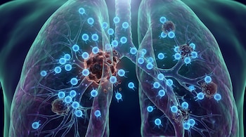 Visualización médica de un pulmón con cáncer, mostrando múltiples masas tumorales marrones rodeadas por numerosas células T azules brillantes, dentro de una estructura ramificada.