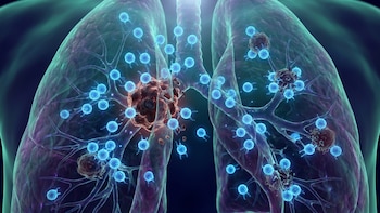 Un nuevo hallazgo logró revitalizar células inmunes agotadas y devolverles la capacidad de atacar al cáncer de pulmón