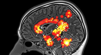 Imagen de resonancia magnética de un cerebro humano en corte sagital con áreas de activación neuronal resaltadas en colores rojo y amarillo, y conexiones blancas.