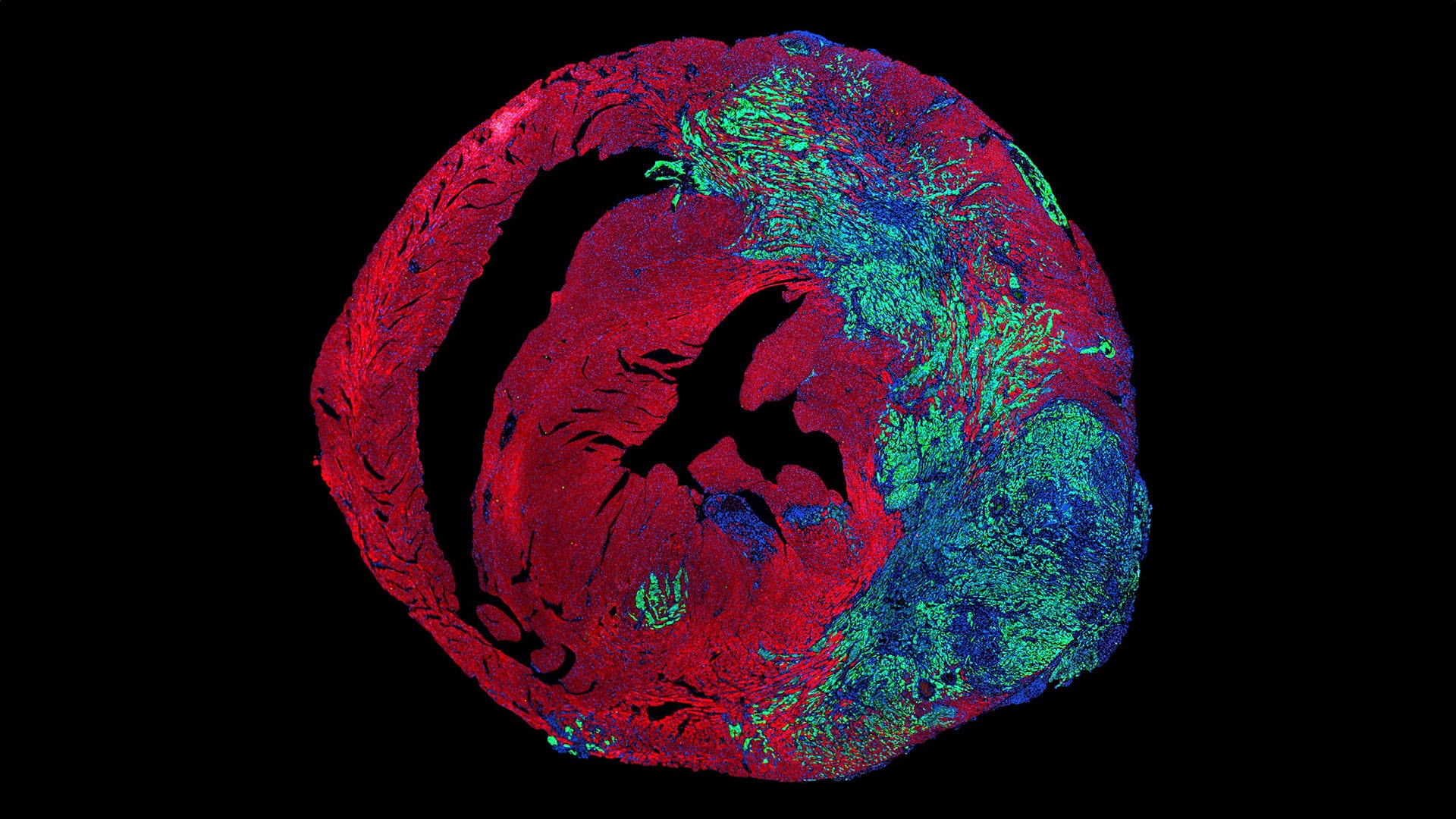 Esta imagen obtenida por los científicos que publicaron en Science muestra la expansión de células cancerosas en el tejido cardíaco y su relación con las células del corazón y sus núcleos (Ciucci et al., Science 2026)