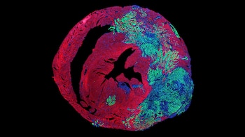 Sección transversal de un corazón bajo microscopio, mostrando tejido en tonos rojos, verdes y azules, con posibles áreas de células cancerosas