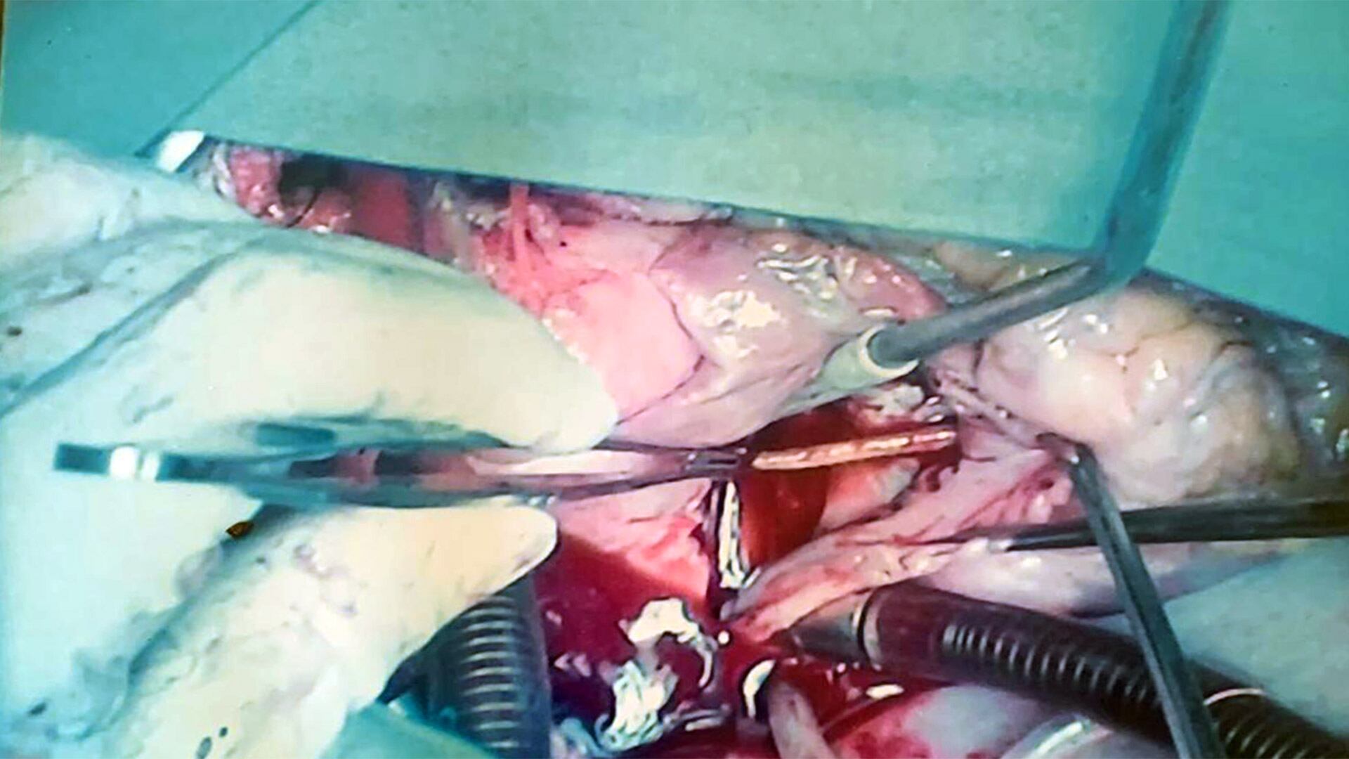 La imagen del momento de la extracción. El escarbadientes le había quedado alojado en el ventrículo derecho del corazón