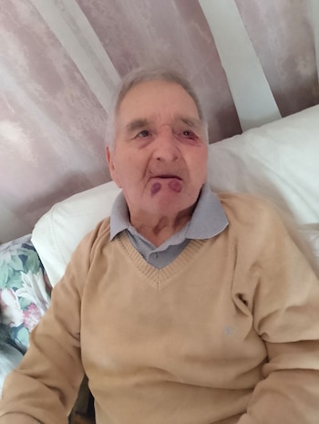 Las lesiones debajo de la