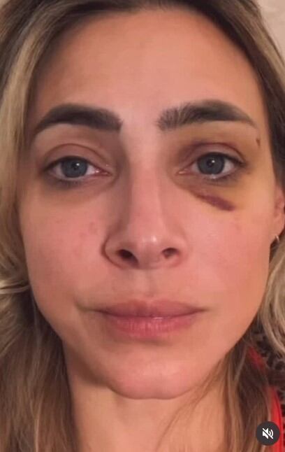 El video difundido por Edna Monroy muestra lesiones en su rostro y detalla que es la segunda agresión sufrida (IG)