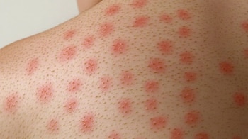 Pitiriasis rosada, manchas rosadas en la piel, condición dermatológica, irritación cutánea, lesiones en la piel, tratamiento dermatológico.