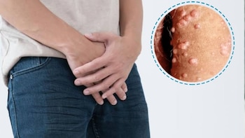 El VPH no solo afecta a mujeres, hombres también pueden desarrollar cáncer de ano, pene y garganta: ¿Cómo evitarlo?