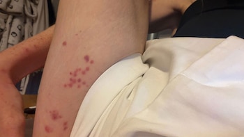 Fue a un hotel por una noche y terminó cubierta de picaduras de chinches