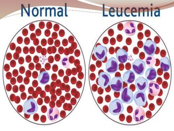 La Leucemia Mieloide Crónica afecta
